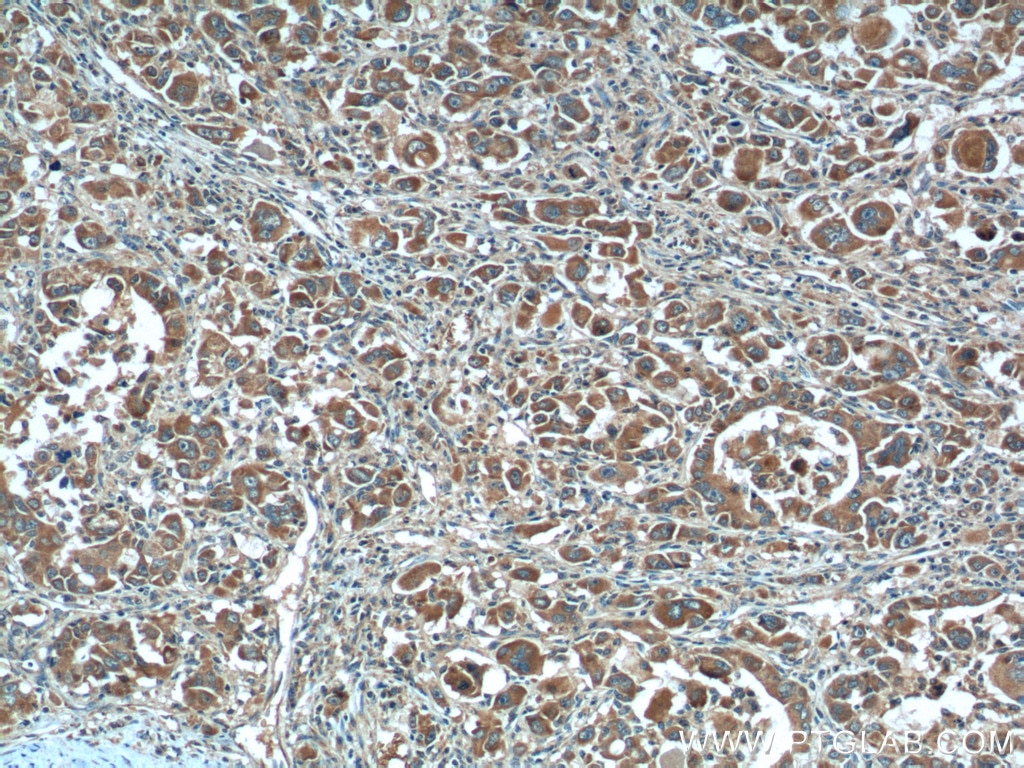 Immunohistochemistry (IHC) staining of human liver cancer tissue using XBP1S-specific Polyclonal antibody (24868-1-AP)