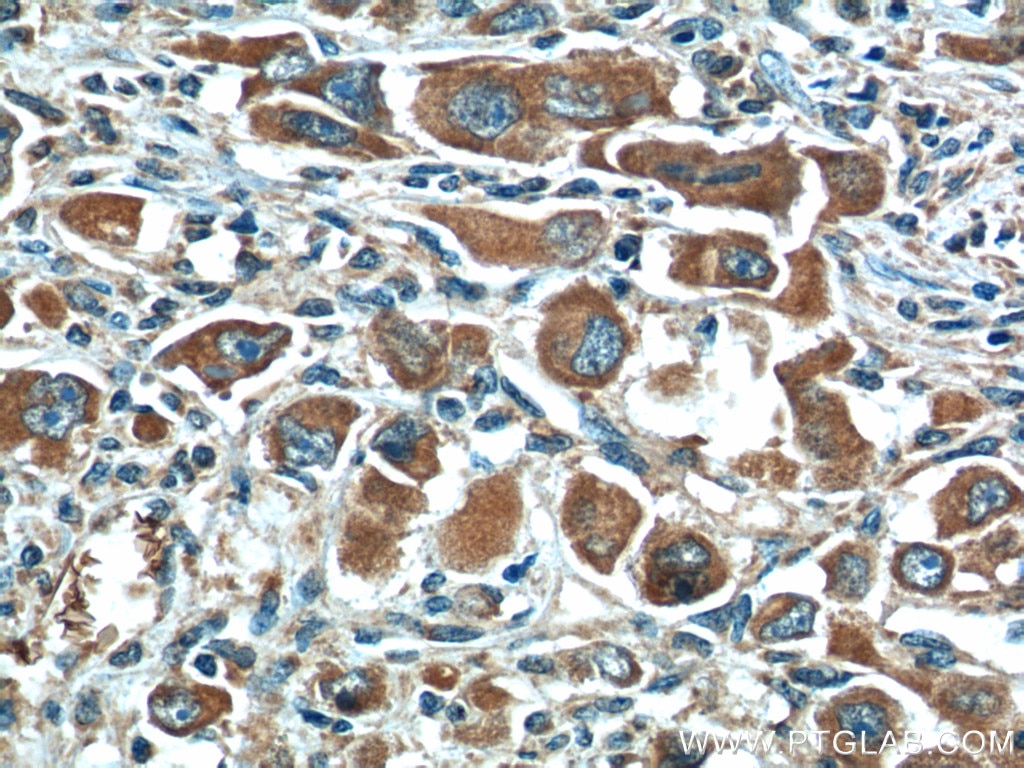 Immunohistochemistry (IHC) staining of human liver cancer tissue using XBP1S-specific Polyclonal antibody (24868-1-AP)
