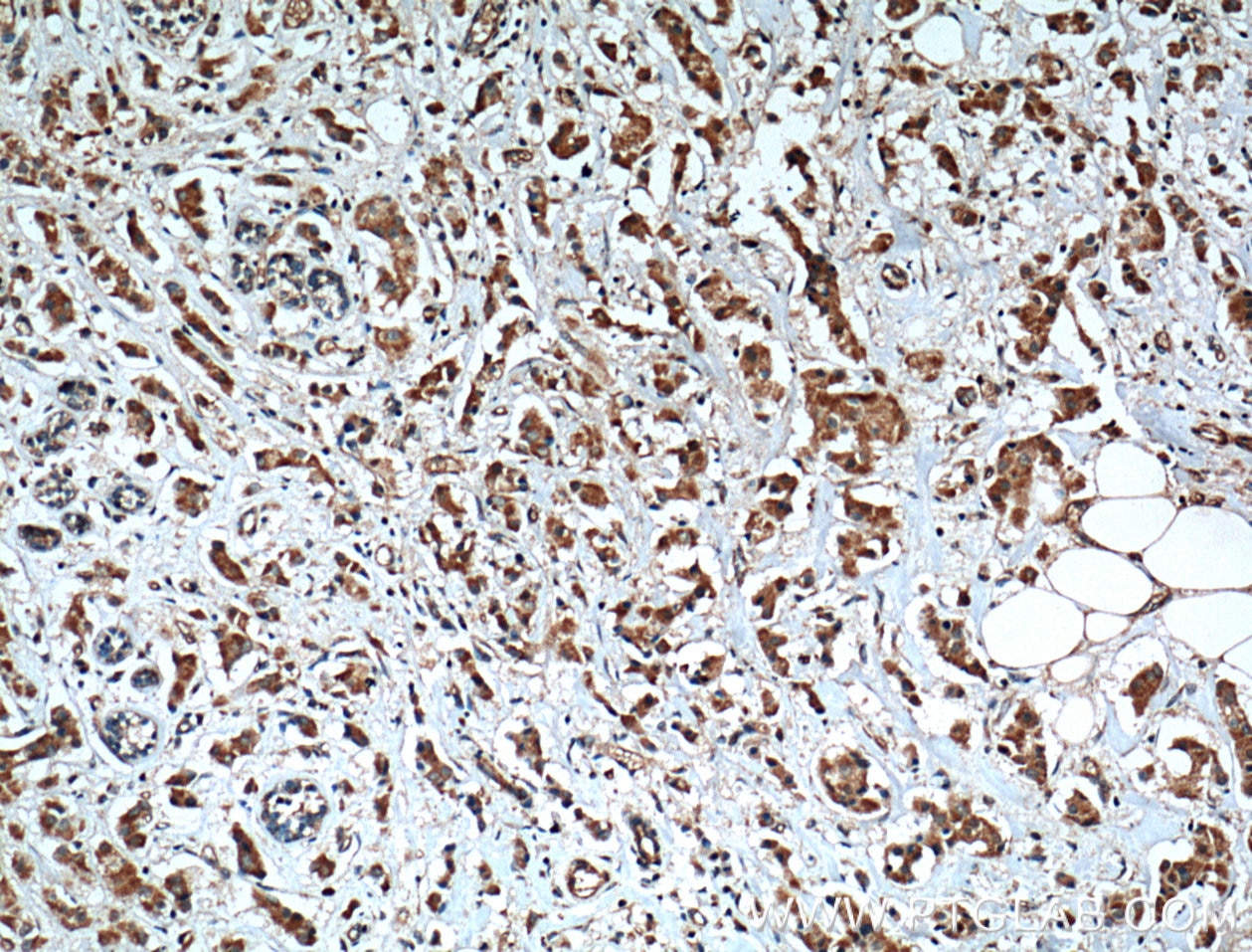 Immunohistochemistry (IHC) staining of human breast cancer tissue using XBP1S-specific Polyclonal antibody (24868-1-AP)
