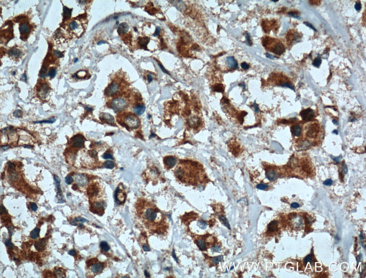 Immunohistochemistry (IHC) staining of human breast cancer tissue using XBP1S-specific Polyclonal antibody (24868-1-AP)