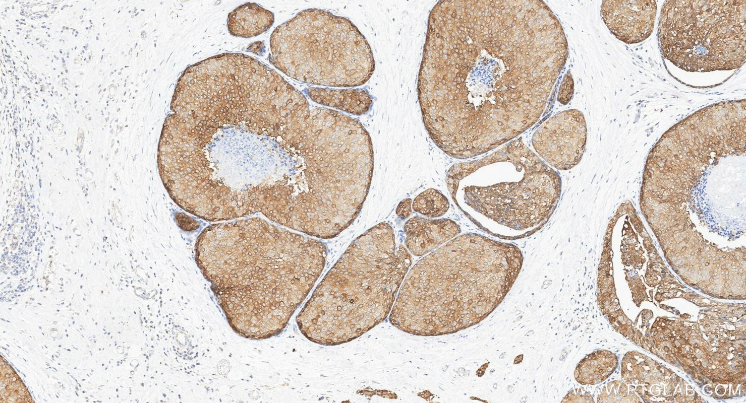 IHC staining of human breast cancer using 24868-1-AP Immunohistochemistry (IHC) staining of human breast cancer tissue using XBP1S-specific Polyclonal antibody (24868-1-AP)