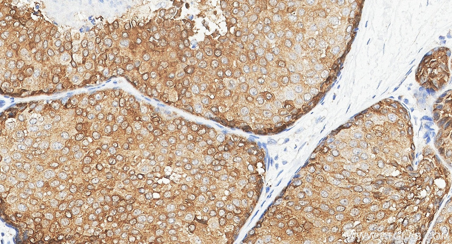 IHC staining of human breast cancer using 24868-1-AP Immunohistochemistry (IHC) staining of human breast cancer tissue using XBP1S-specific Polyclonal antibody (24868-1-AP)