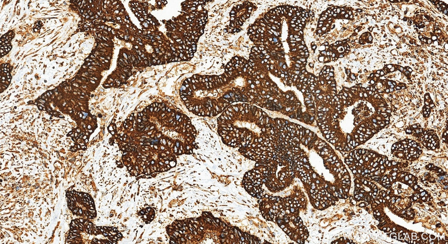 Immunohistochemical analysis of paraffin-embedded human colon cancer tissue slide using 83959-5-RR (XBP1S-specific antibody) at dilution of 1:1000 (under 20x lens). Heat mediated antigen retrieval with Tris-EDTA buffer (pH 9.0). Immunohistochemistry (IHC) staining of human colon cancer tissue using XBP1S-specific Recombinant monoclonal antibody (83959-5-RR)