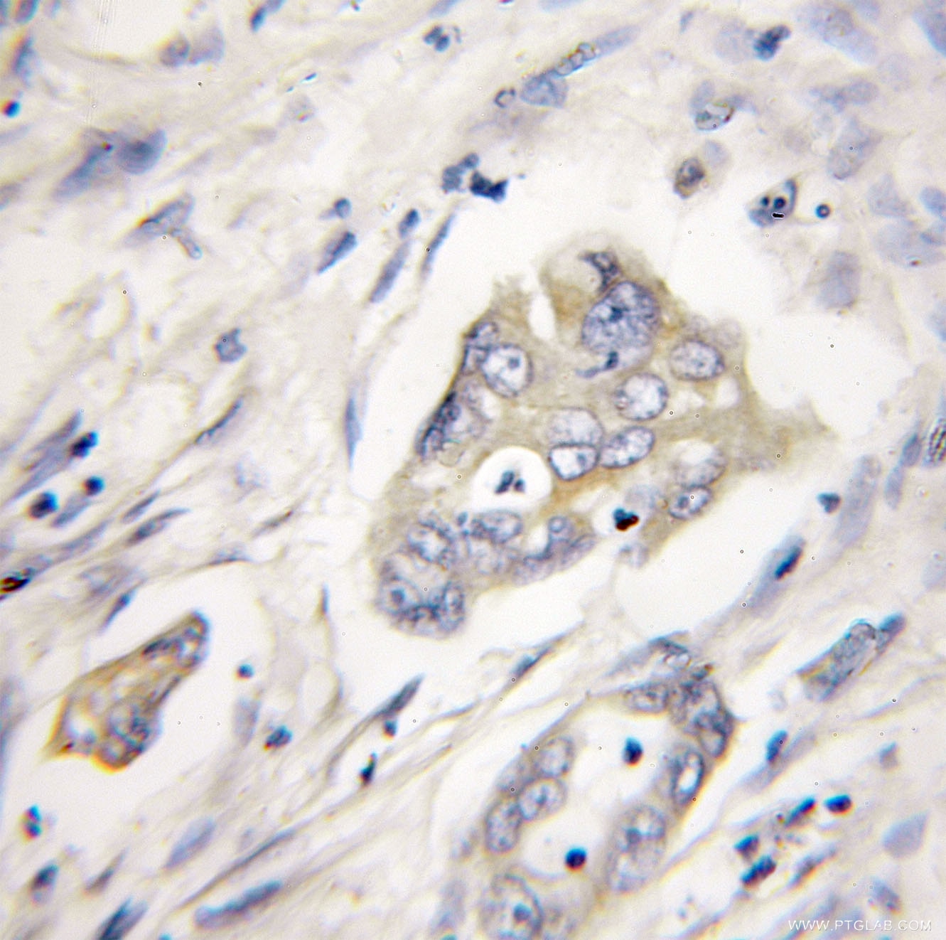 Immunohistochemistry (IHC) staining of human pancreas cancer tissue using XIAP Polyclonal antibody (10037-1-Ig)