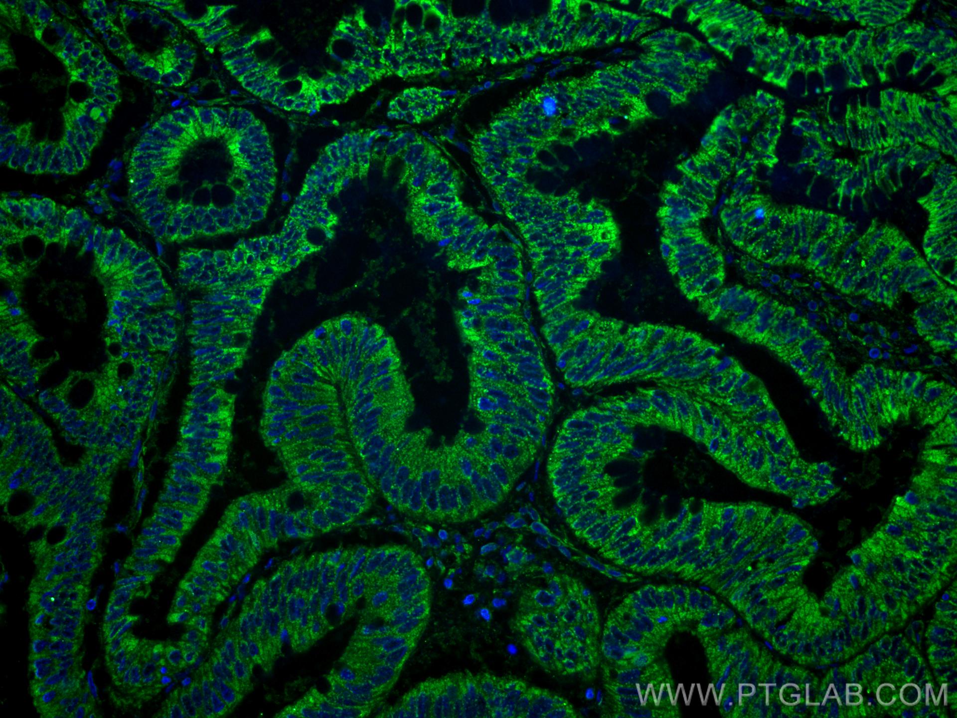Immunofluorescence (IF) / fluorescent staining of human colon cancer tissue using XIAP Monoclonal antibody (66800-1-Ig)