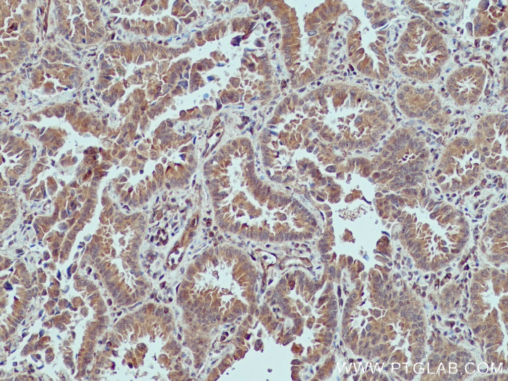 IHC staining of human lung cancer using 66800-1-Ig