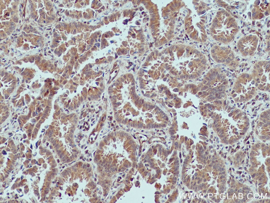 Immunohistochemistry (IHC) staining of human lung cancer tissue using XIAP Monoclonal antibody (66800-1-Ig)