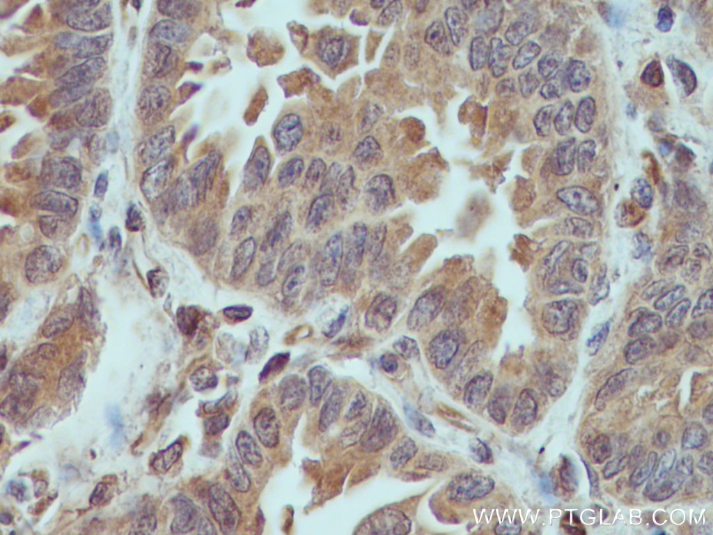 Immunohistochemistry (IHC) staining of human lung cancer tissue using XIAP Monoclonal antibody (66800-1-Ig)