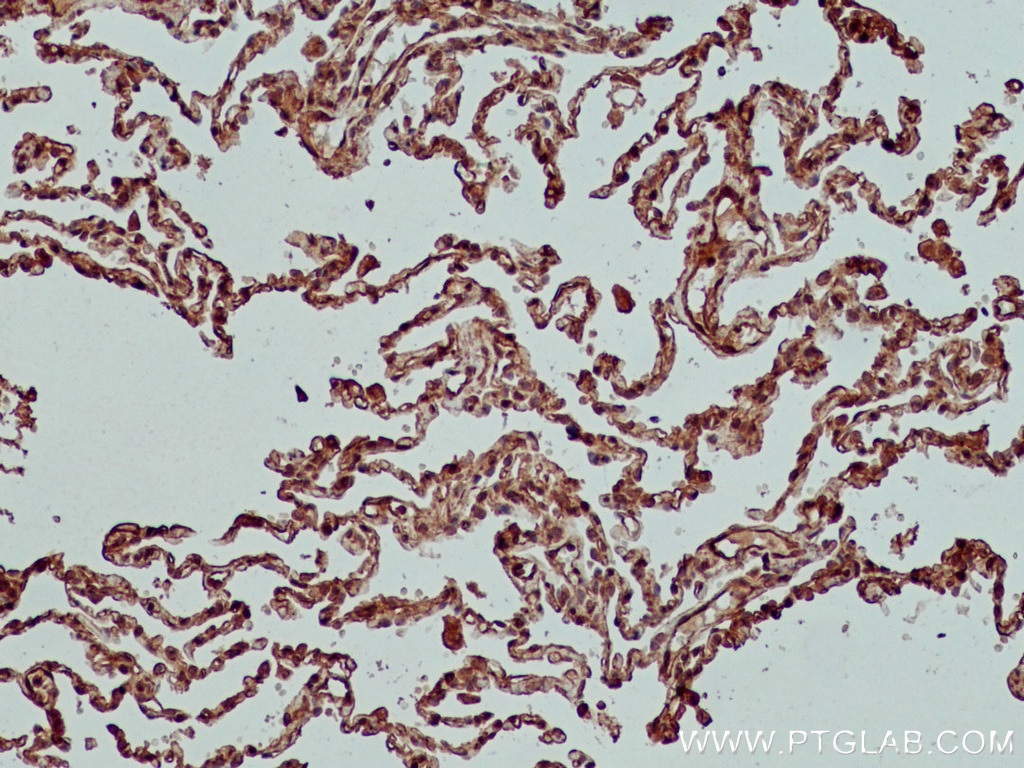 Immunohistochemistry (IHC) staining of human lung cancer tissue using XIAP Monoclonal antibody (66800-1-Ig)