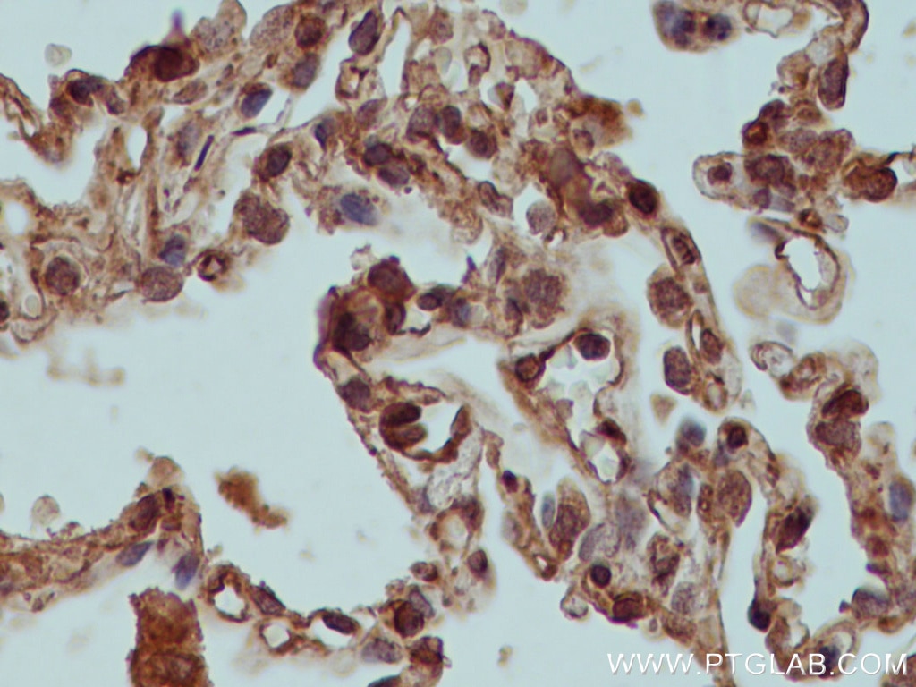 IHC staining of human lung cancer using 66800-1-Ig