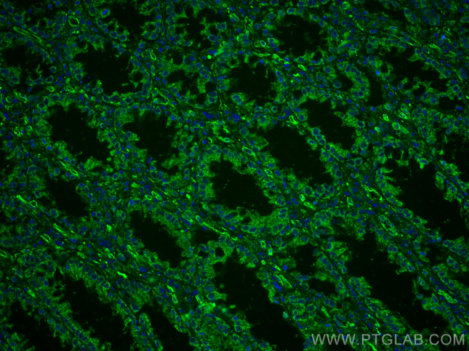 Immunofluorescence (IF) / fluorescent staining of human colon cancer tissue using CoraLite® Plus 488-conjugated XIAP Monoclonal anti (CL488-66800)