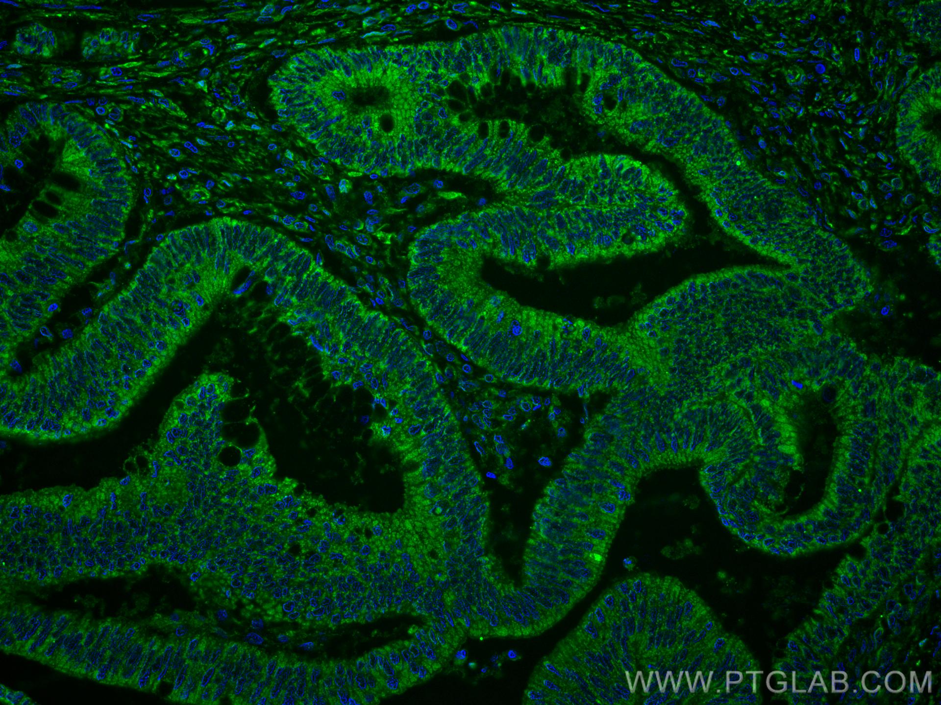 Immunofluorescence (IF) / fluorescent staining of human colon cancer tissue using CoraLite® Plus 488-conjugated XIAP Monoclonal anti (CL488-66800)