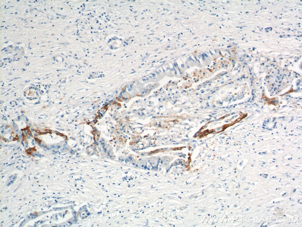 Immunohistochemistry (IHC) staining of human pancreas cancer tissue using XK Polyclonal antibody (12830-1-AP)