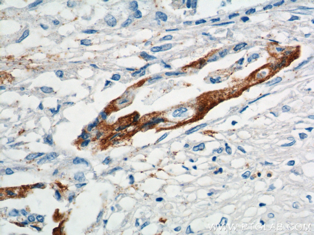 Immunohistochemistry (IHC) staining of human pancreas cancer tissue using XK Polyclonal antibody (12830-1-AP)