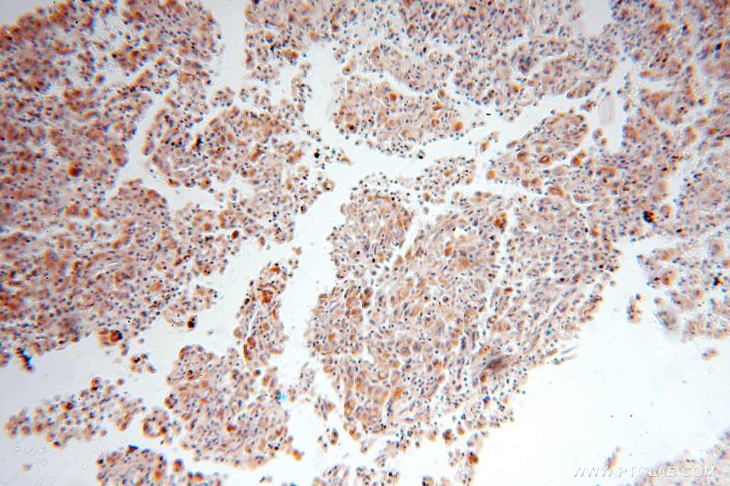 Immunohistochemistry (IHC) staining of human lung cancer tissue using XPNPEP3 Polyclonal antibody (15655-1-AP)