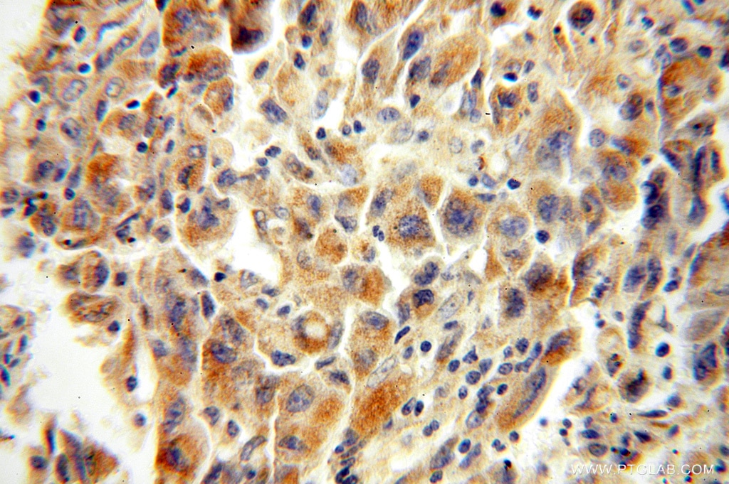 Immunohistochemistry (IHC) staining of human lung cancer tissue using XPNPEP3 Polyclonal antibody (15655-1-AP)