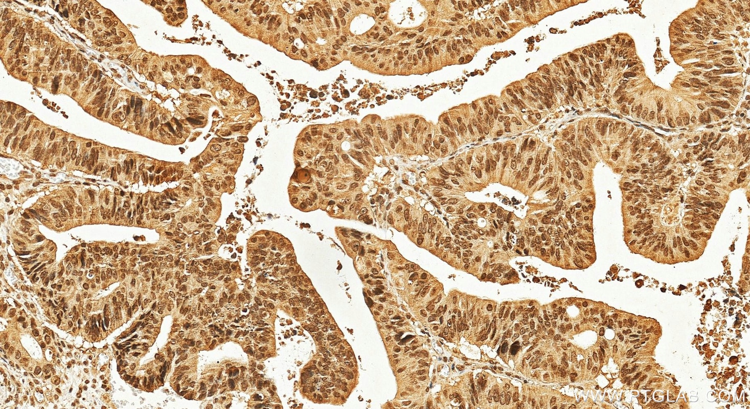 Immunohistochemistry (IHC) staining of human colon cancer tissue using CRM1 Monoclonal antibody (66763-1-Ig)