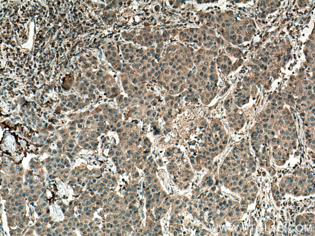 IHC staining of human breast cancer using 66763-1-Ig