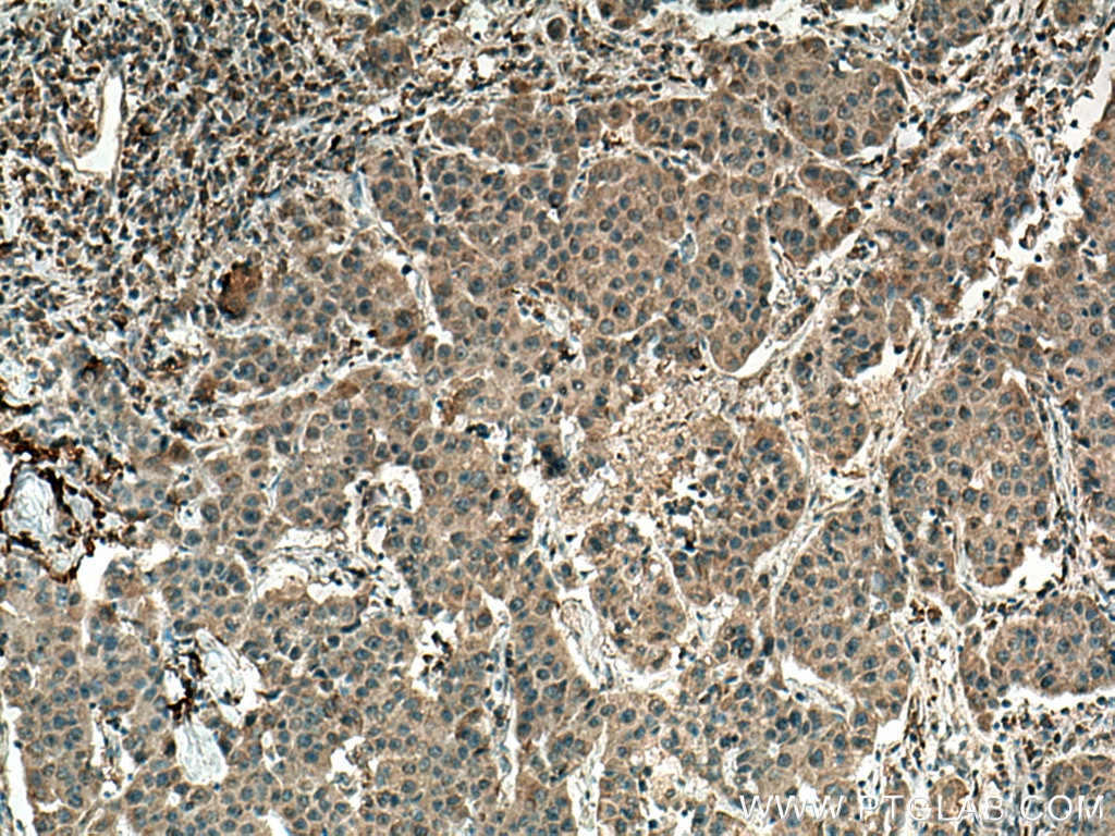 Immunohistochemistry (IHC) staining of human breast cancer tissue using CRM1 Monoclonal antibody (66763-1-Ig)