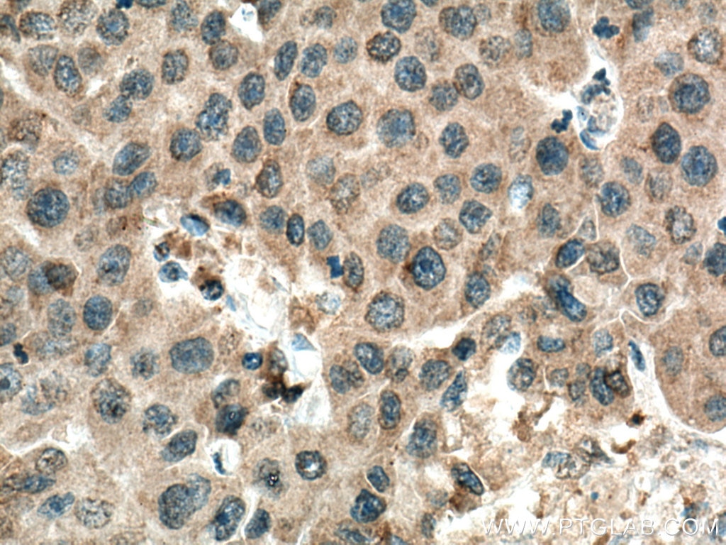 Immunohistochemistry (IHC) staining of human breast cancer tissue using CRM1 Monoclonal antibody (66763-1-Ig)