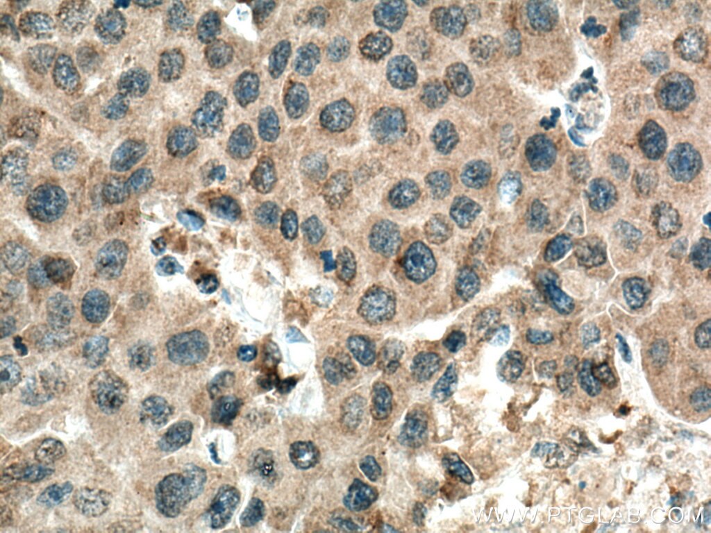 IHC staining of human breast cancer using 66763-1-Ig