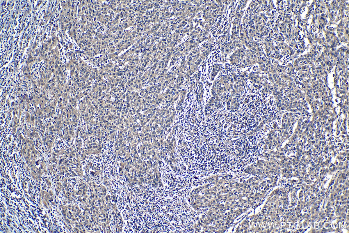 Immunohistochemistry (IHC) staining of human cervical cancer tissue using CRM1 Monoclonal antibody (66763-1-Ig)