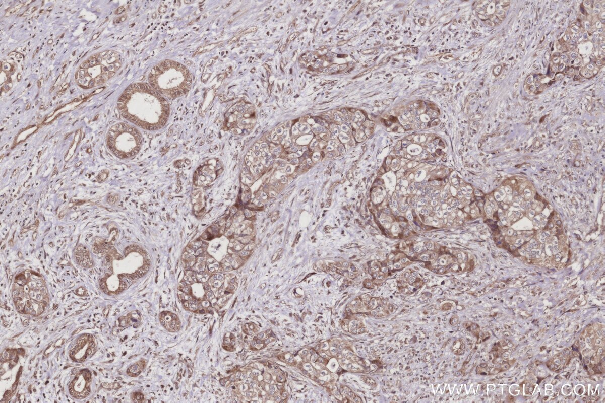 IHC staining of human pancreas cancer using 28628-1-AP Immunohistochemistry (IHC) staining of human pancreas cancer tissue using XPO5 Polyclonal antibody (28628-1-AP)