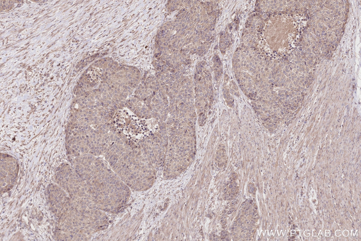 Immunohistochemistry (IHC) staining of human stomach cancer tissue using XPO6 Polyclonal antibody (11408-1-AP)