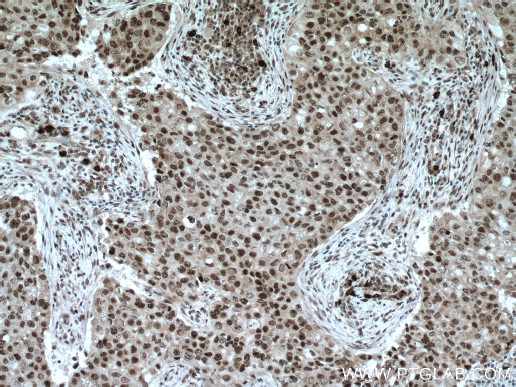 Immunohistochemistry (IHC) staining of human breast cancer tissue using XRCC4 Polyclonal antibody (15817-1-AP)