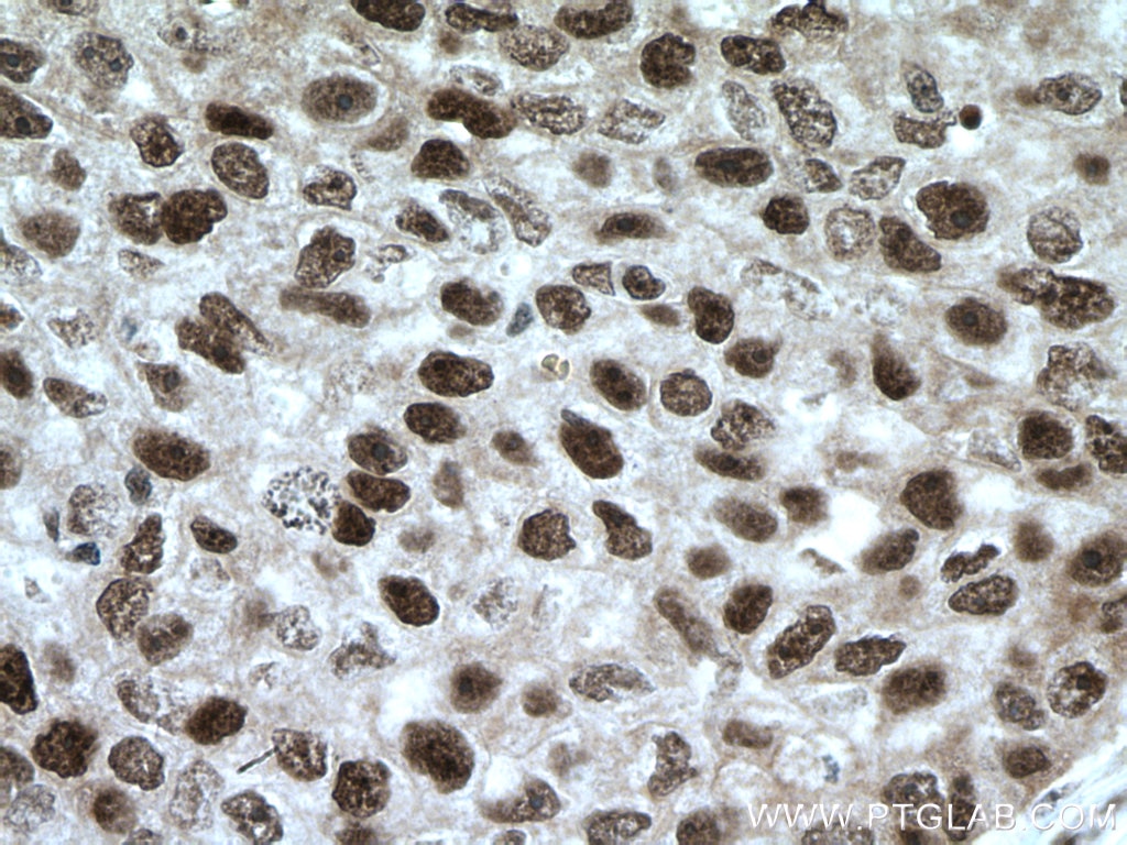 Immunohistochemistry (IHC) staining of human breast cancer tissue using XRCC4 Polyclonal antibody (15817-1-AP)