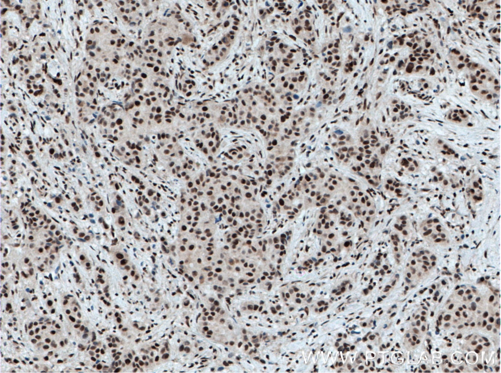 Immunohistochemistry (IHC) staining of human breast cancer tissue using XRCC4 Monoclonal antibody (66621-1-Ig)