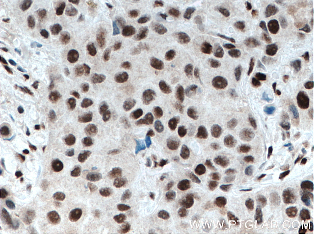 IHC staining of human breast cancer using 66621-1-Ig