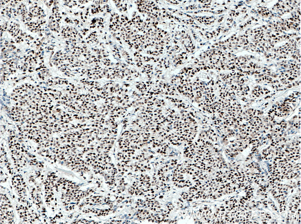 Immunohistochemistry (IHC) staining of human colon cancer tissue using XRCC4 Monoclonal antibody (66621-1-Ig)