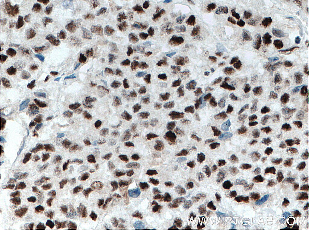 Immunohistochemistry (IHC) staining of human colon cancer tissue using XRCC4 Monoclonal antibody (66621-1-Ig)