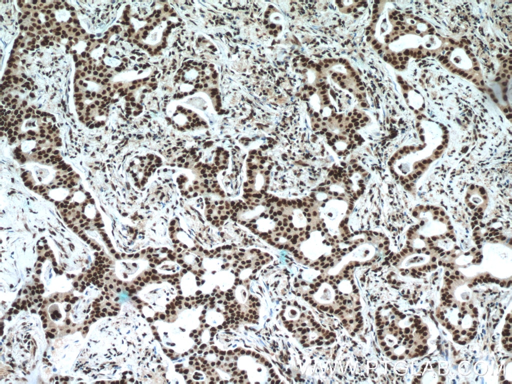 Immunohistochemistry (IHC) staining of human lung cancer tissue using XRCC5/Ku80 Polyclonal antibody (16389-1-AP)