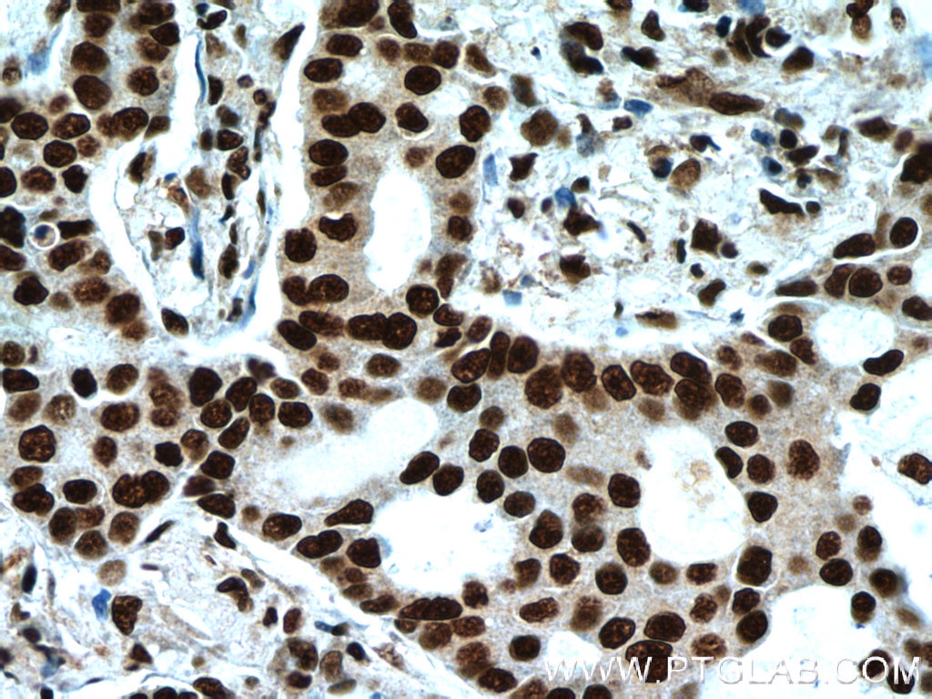 Immunohistochemistry (IHC) staining of human lung cancer tissue using XRCC5/Ku80 Polyclonal antibody (16389-1-AP)