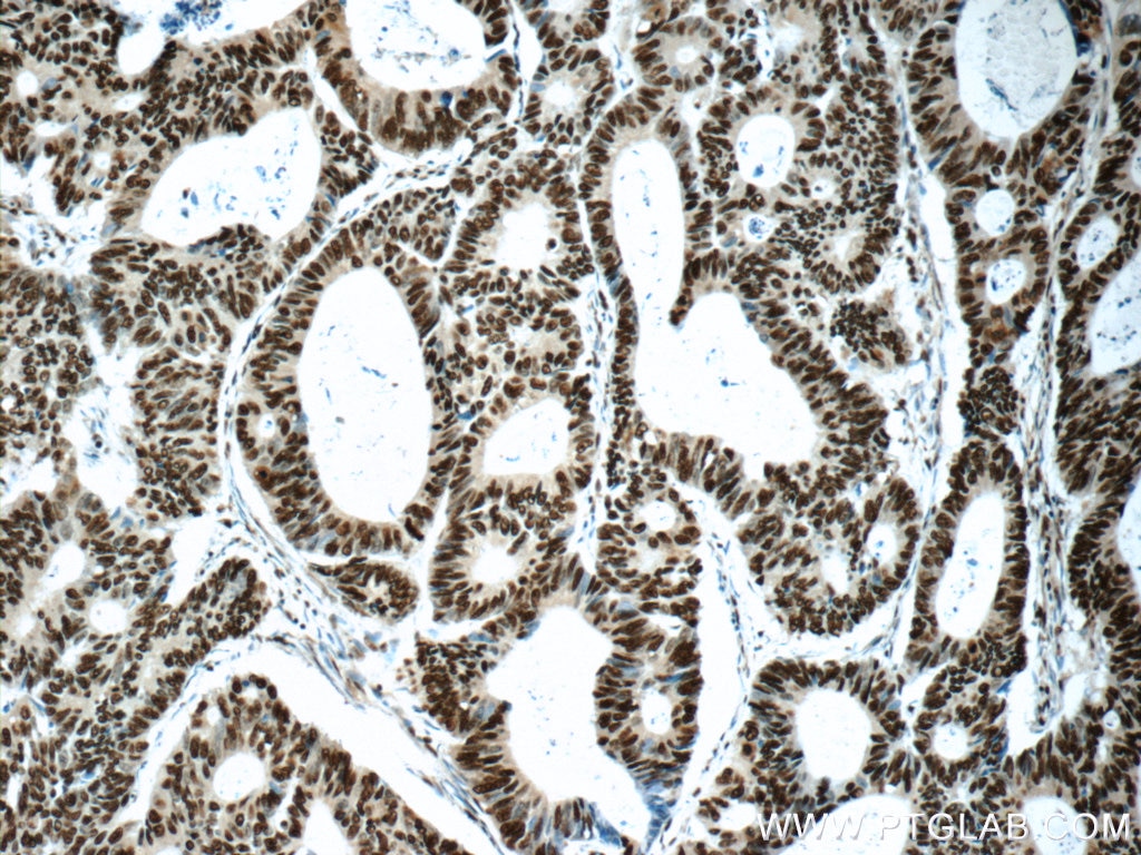 Immunohistochemistry (IHC) staining of human colon cancer tissue using XRCC5/Ku80 Polyclonal antibody (16389-1-AP)