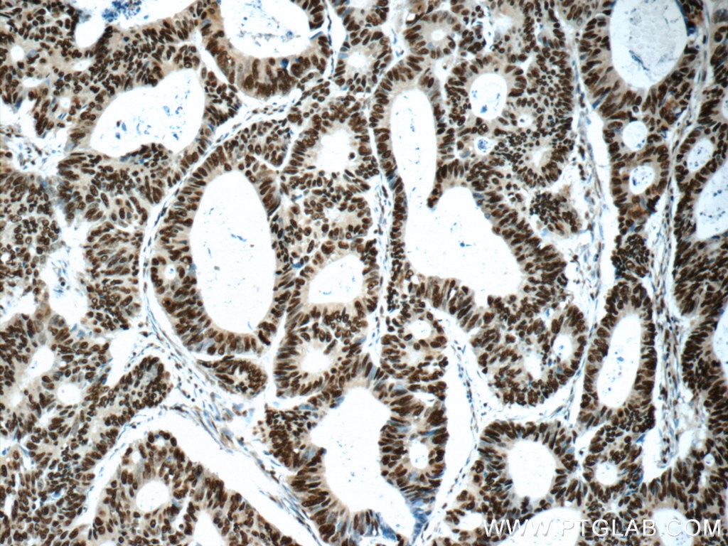 IHC staining of human colon cancer using 16389-1-AP