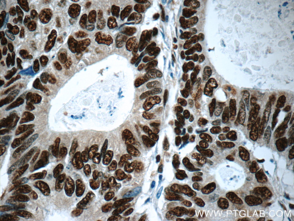 Immunohistochemistry (IHC) staining of human colon cancer tissue using XRCC5/Ku80 Polyclonal antibody (16389-1-AP)