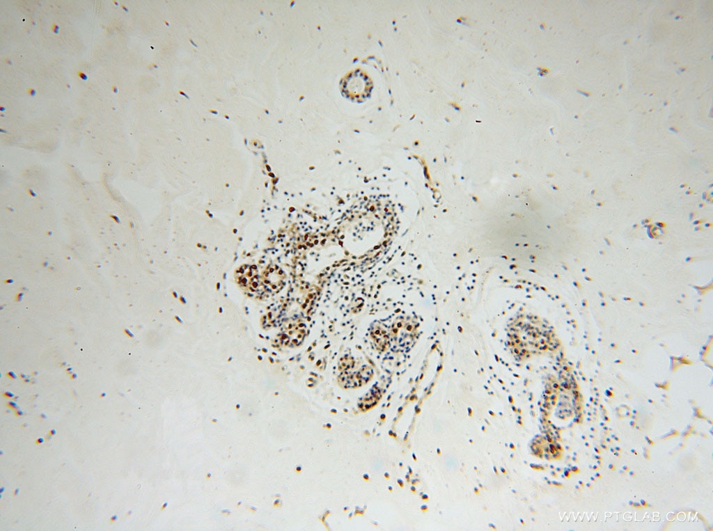 Immunohistochemistry (IHC) staining of human colon cancer tissue using XRCC5/Ku80 Polyclonal antibody (16389-1-AP)