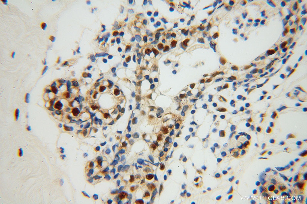 Immunohistochemistry (IHC) staining of human colon cancer tissue using XRCC5/Ku80 Polyclonal antibody (16389-1-AP)