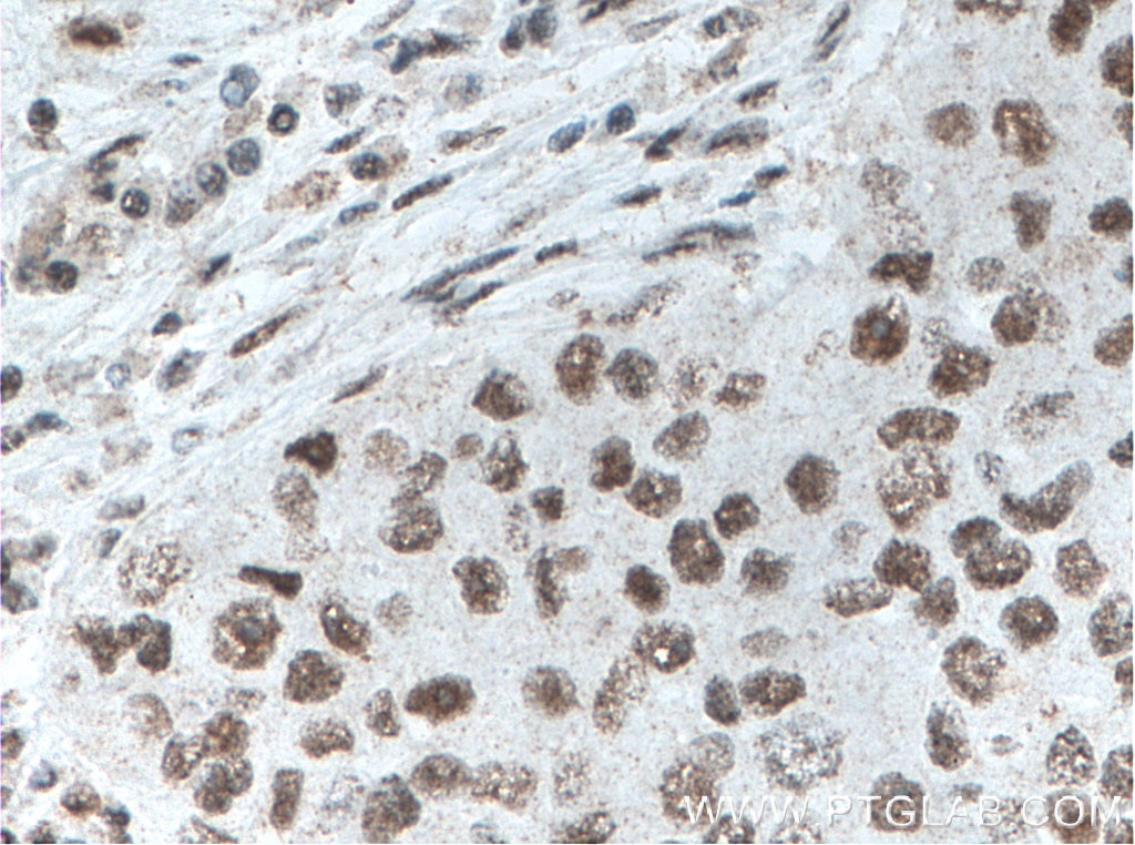 Immunohistochemistry (IHC) staining of human breast cancer tissue using XRCC5 Monoclonal antibody (66546-1-Ig)