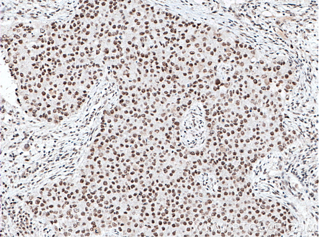 Immunohistochemistry (IHC) staining of human breast cancer tissue using XRCC5 Monoclonal antibody (66546-1-Ig)