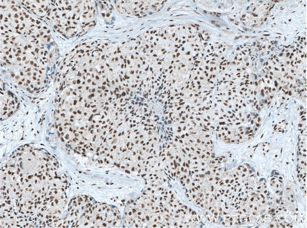 Immunohistochemistry (IHC) staining of human lung cancer tissue using XRCC5 Monoclonal antibody (66546-1-Ig)