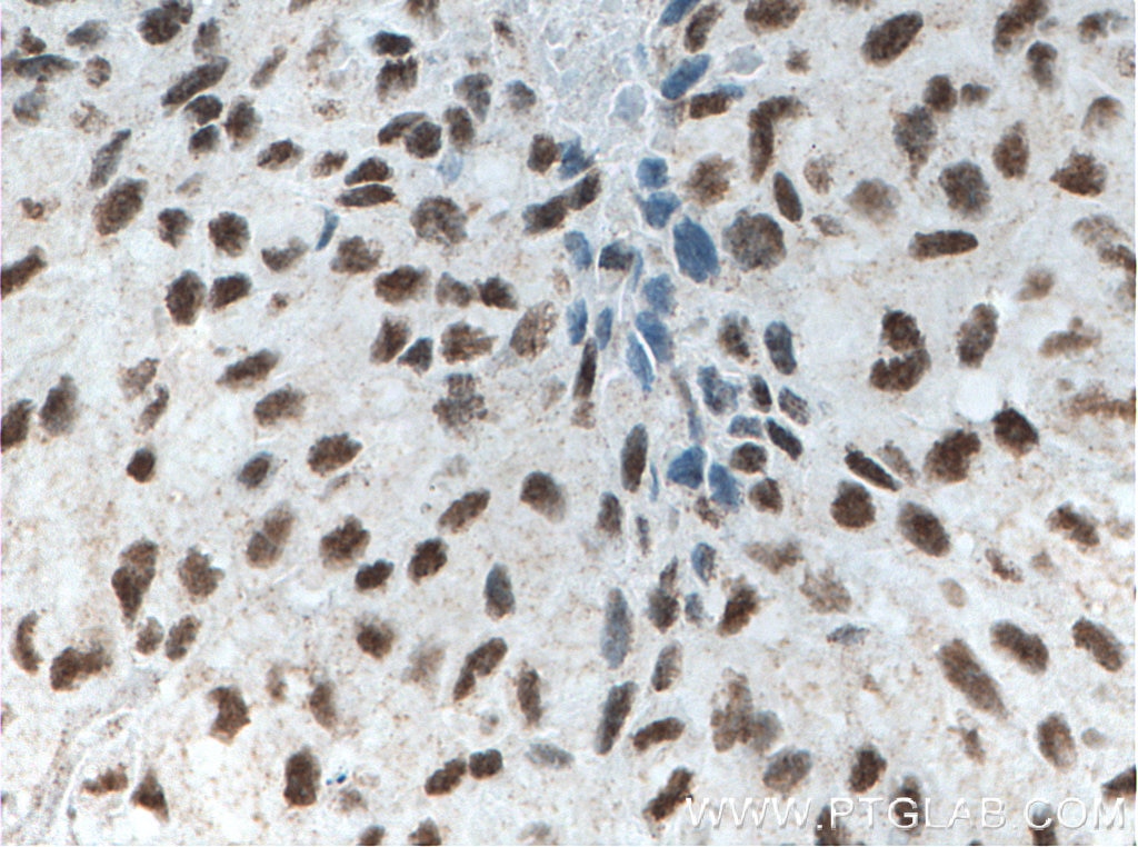 Immunohistochemistry (IHC) staining of human lung cancer tissue using XRCC5 Monoclonal antibody (66546-1-Ig)