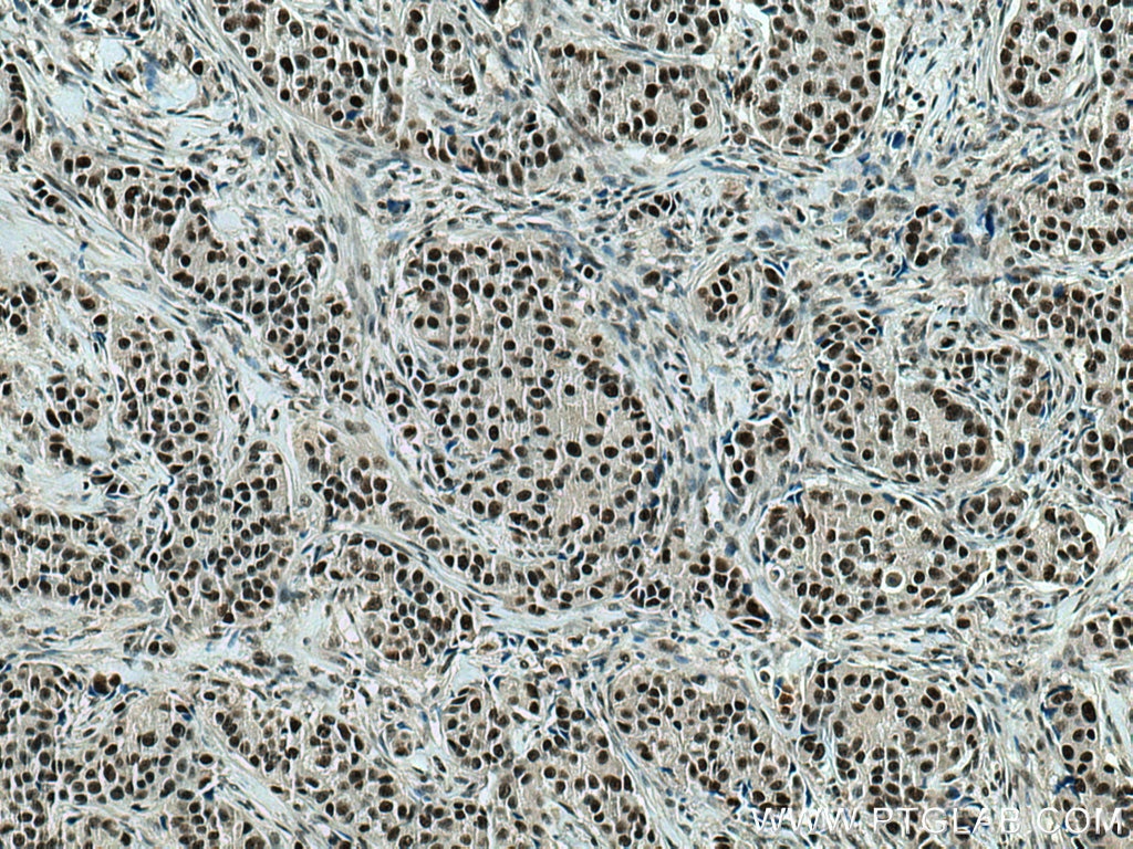 IHC staining of human breast cancer using 66852-1-Ig