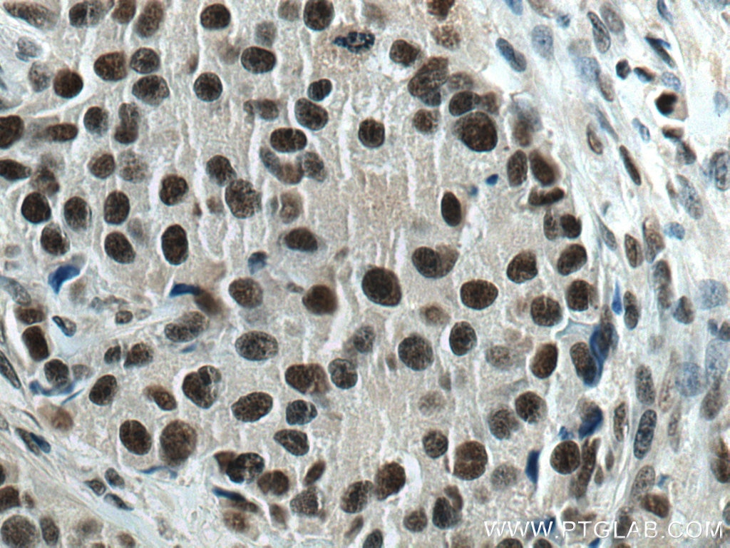 Immunohistochemistry (IHC) staining of human breast cancer tissue using XRN2 Monoclonal antibody (66852-1-Ig)