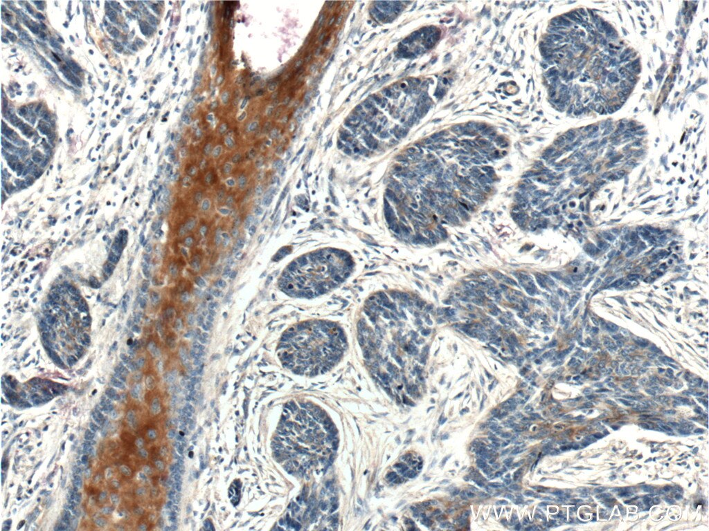 Immunohistochemistry (IHC) staining of human skin cancer tissue using XYLB Polyclonal antibody (26541-1-AP)