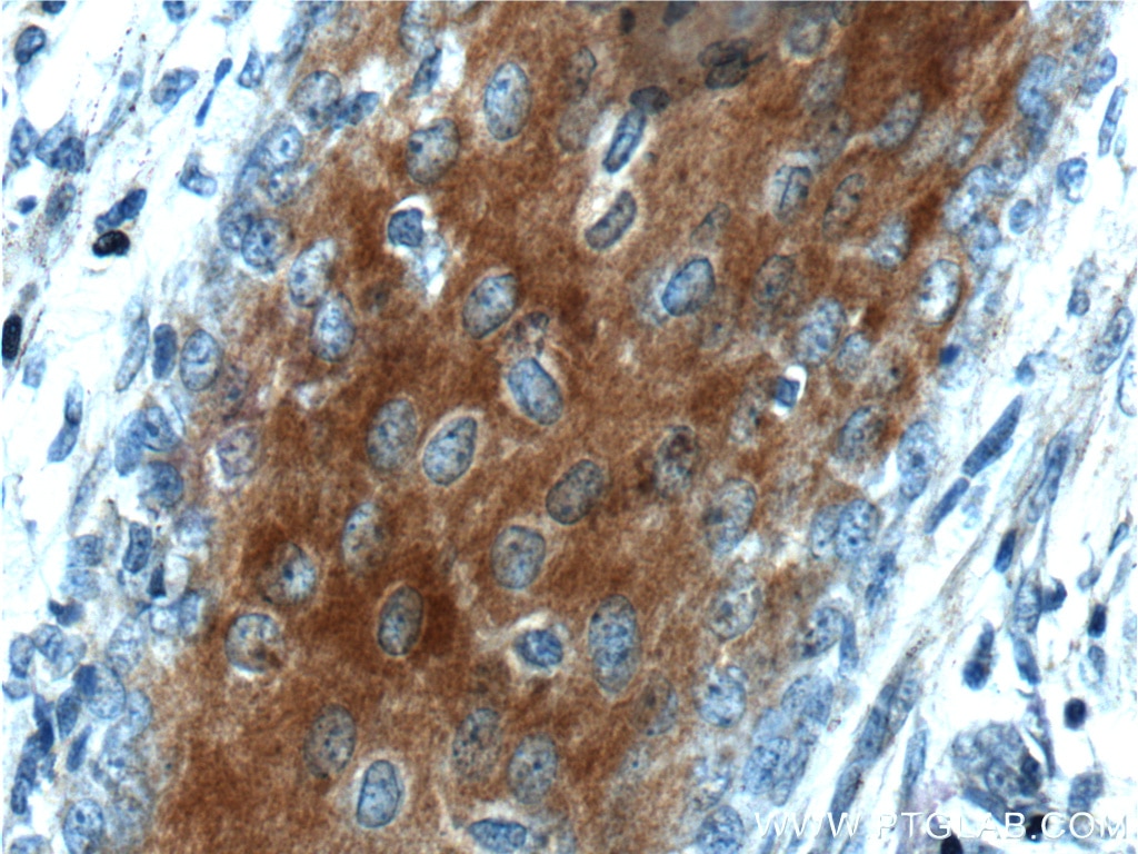 Immunohistochemistry (IHC) staining of human skin cancer tissue using XYLB Polyclonal antibody (26541-1-AP)