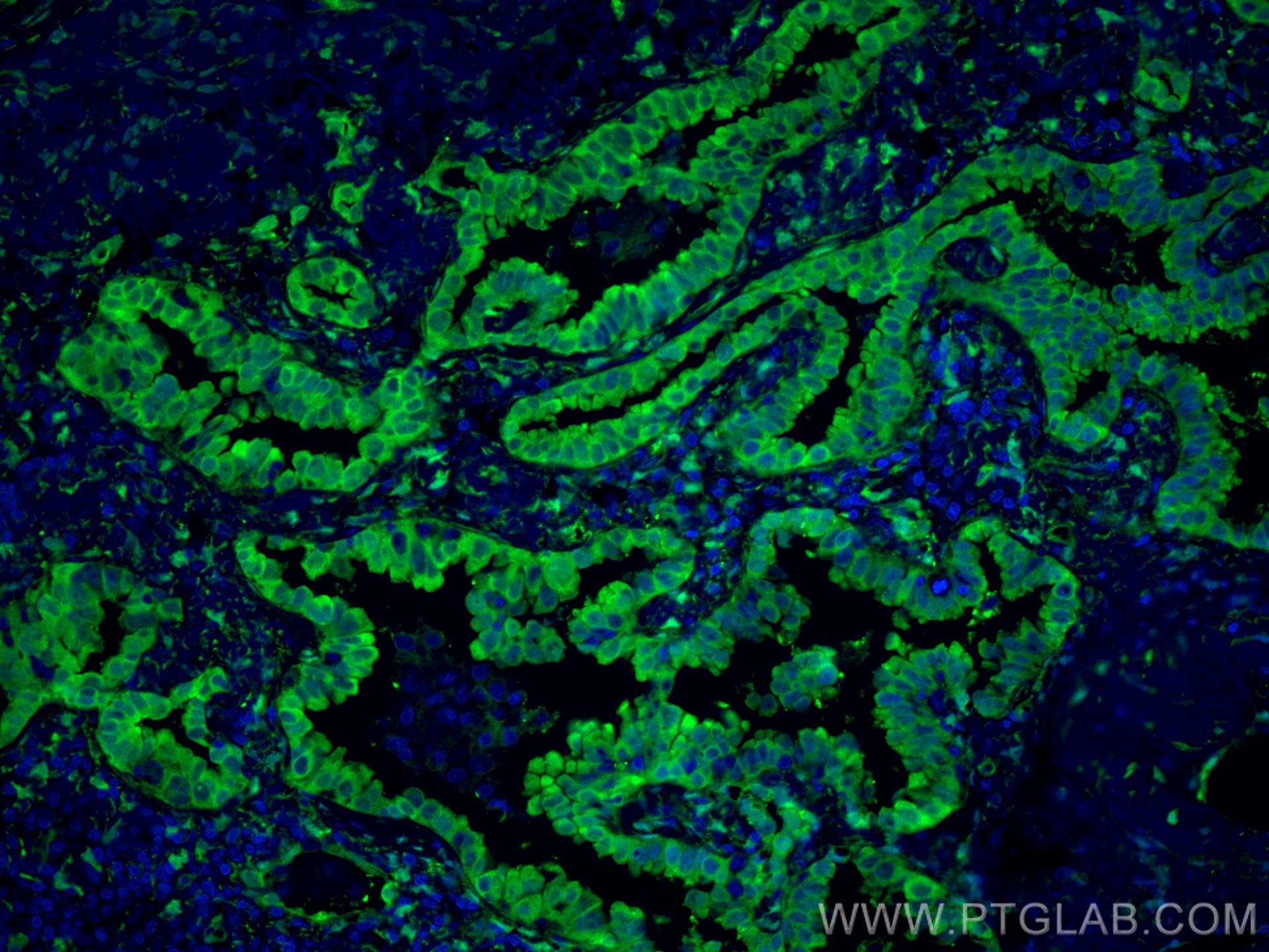 Immunofluorescence (IF) / fluorescent staining of human lung cancer tissue using YAP1 Polyclonal antibody (13584-1-AP)